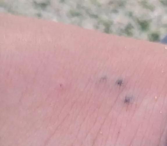 I think my sister stepped on a sea urchin on a beach. We soaked the foot in hot water for now. What should we do?