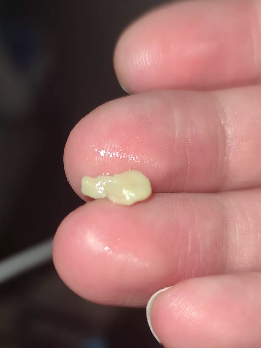 A massive tonsil stone.
