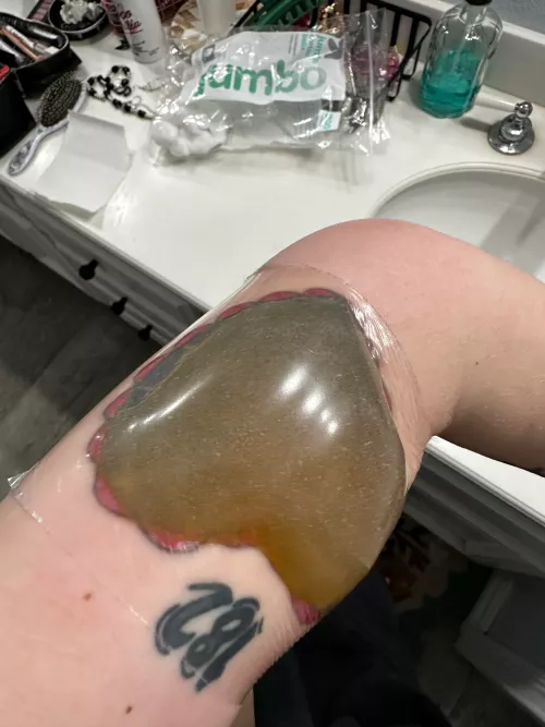 Saw this in the tattoo removal subreddit 😳