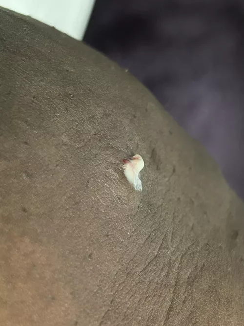 The painful boil on my thigh popped while I was in the bathroom.