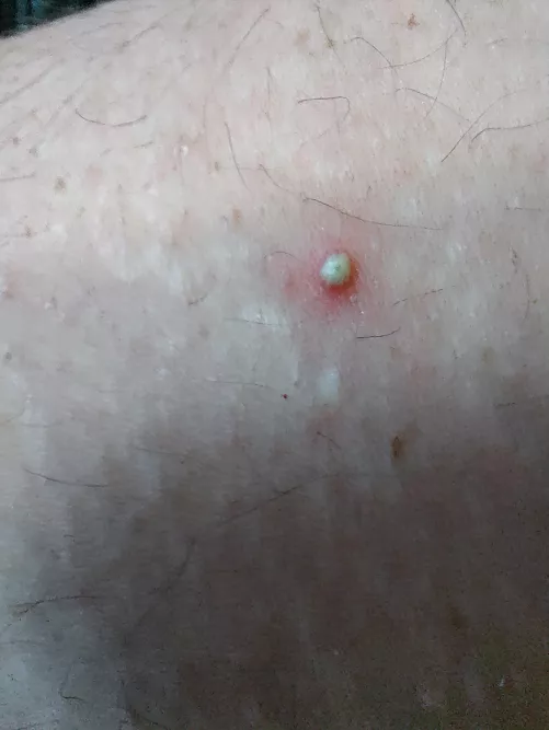 Took my shirt off to get in the shower, this was on my upper arm.