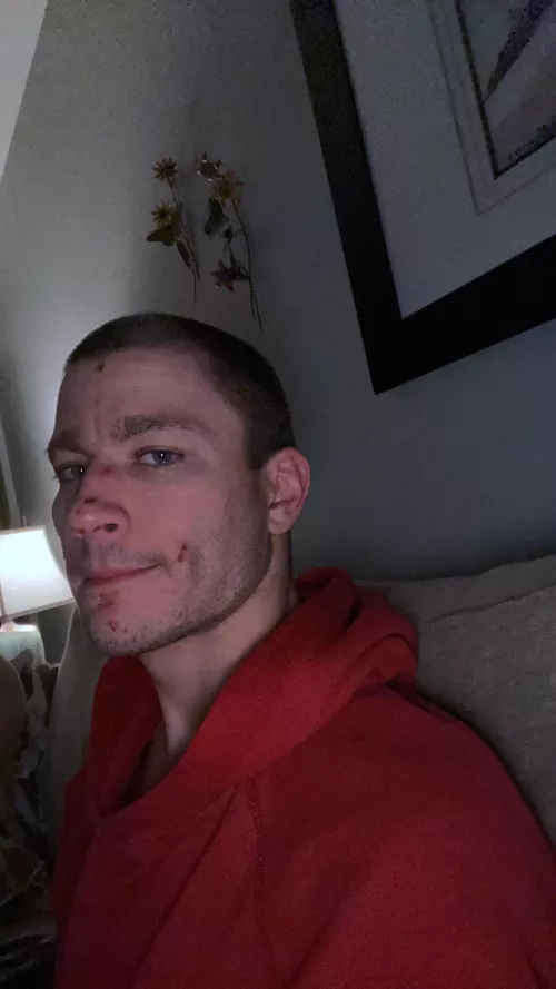 I have a rare skin condition and navigating dating is a tricky thing. I send pics where I don’t have any spots to protect myself from rejection and not accepting it’s part of my identity. Hasn’t worked; If I sent you a face pic would you want me to