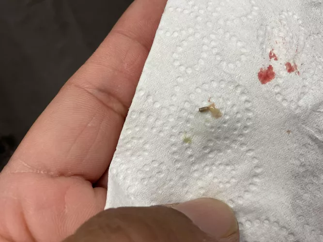 Blackhead/Pimple from the back of my neck.