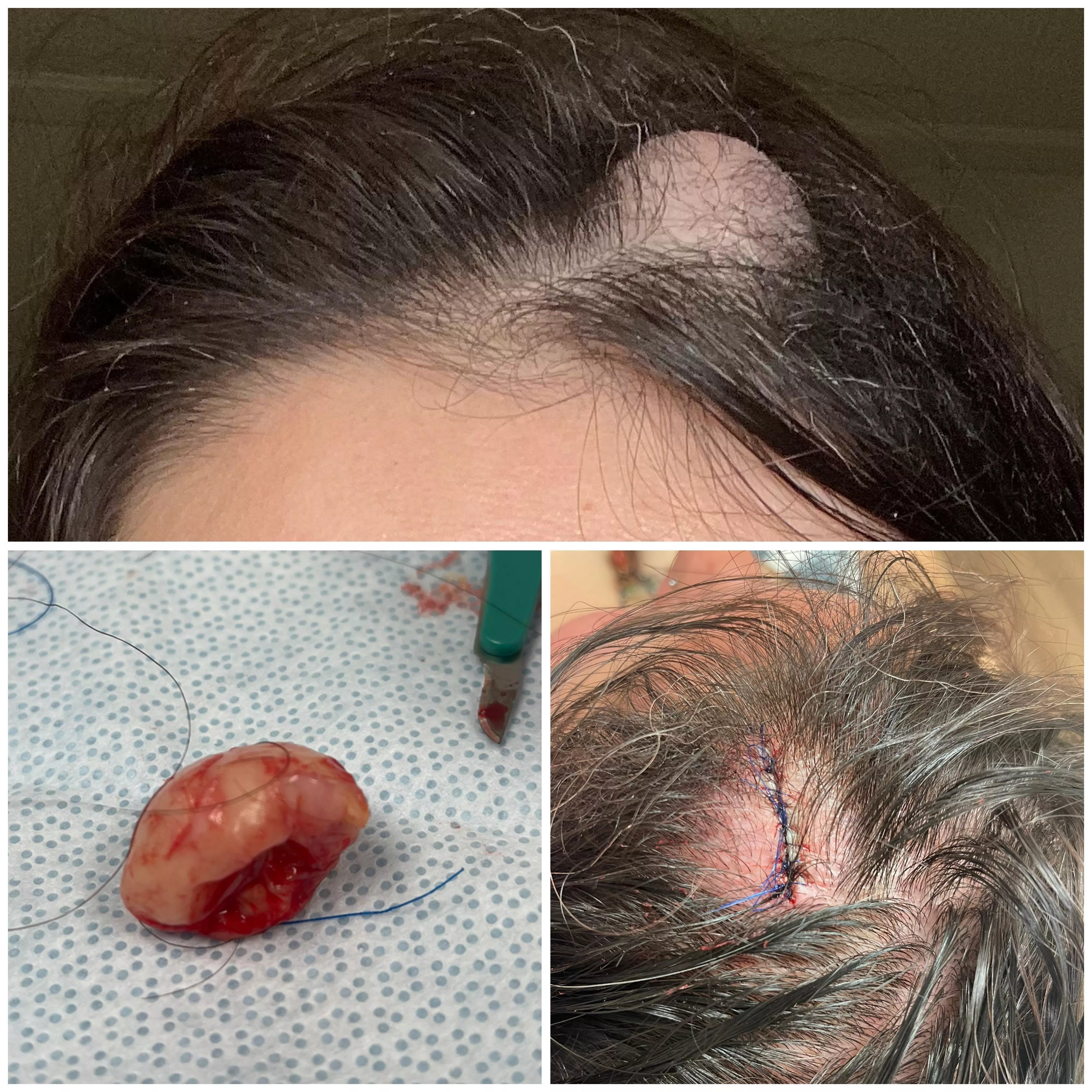 3.9 mm Pilar Cyst Removed & Office Drama, Yesterday