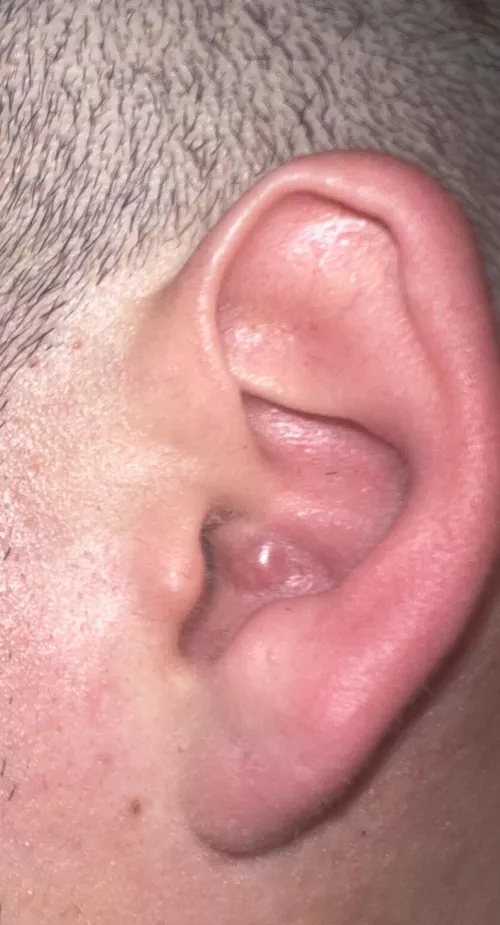 Huge pimple inside ear, what do I do?