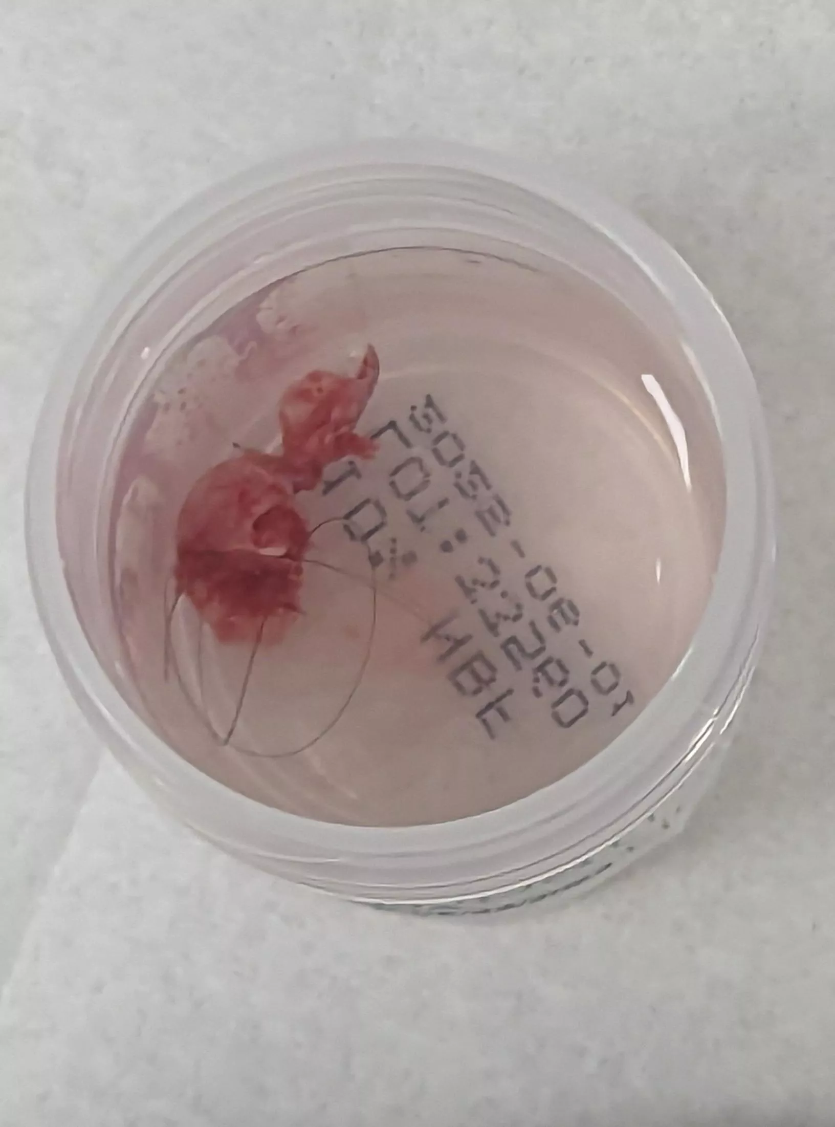 Operation Cease and De-cyst, part VI!