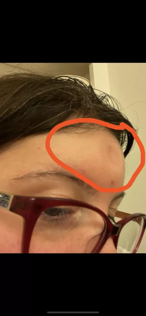 3.9 cm Pilar Cyst Removal: Recovery Question