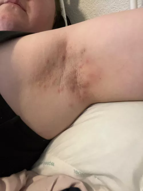 Enjoy my rash from changing deodorant.