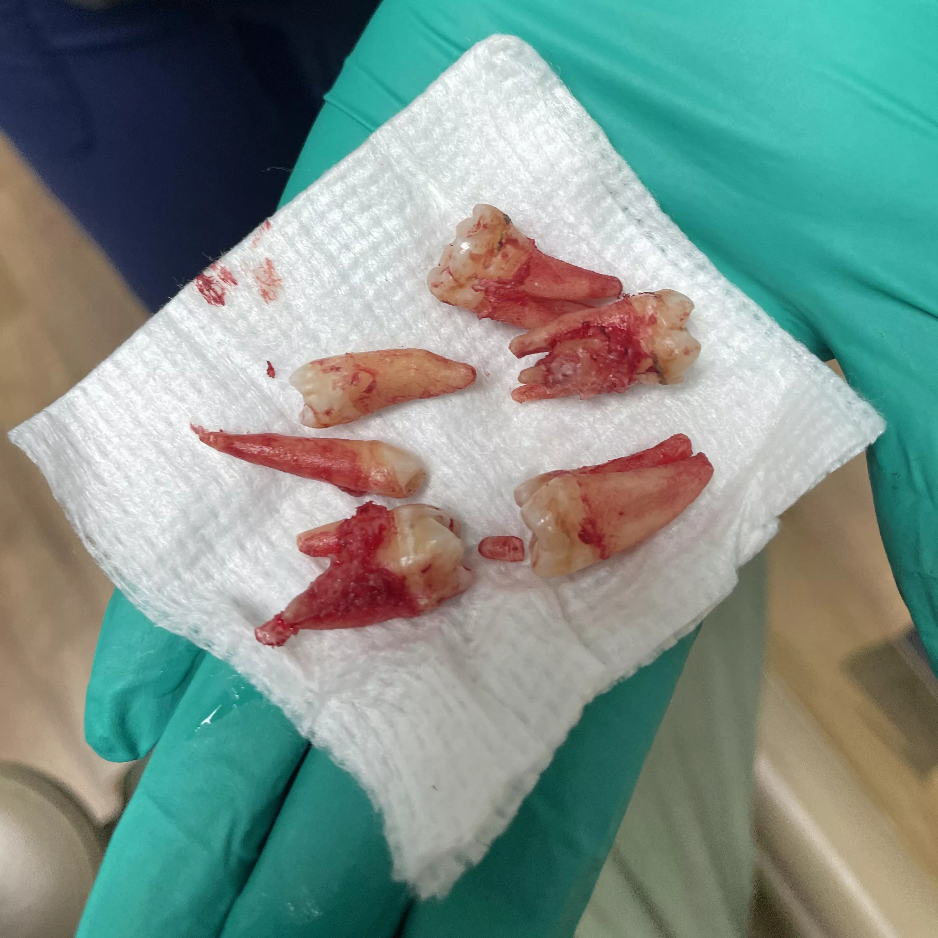 Inspired by the other recent wisdom tooth removal post: 4 wisdom and 2 “shark” teeth pulled in one session.