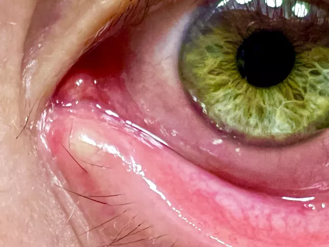 Day 3 of This Stye *Right* on my Tear Duct