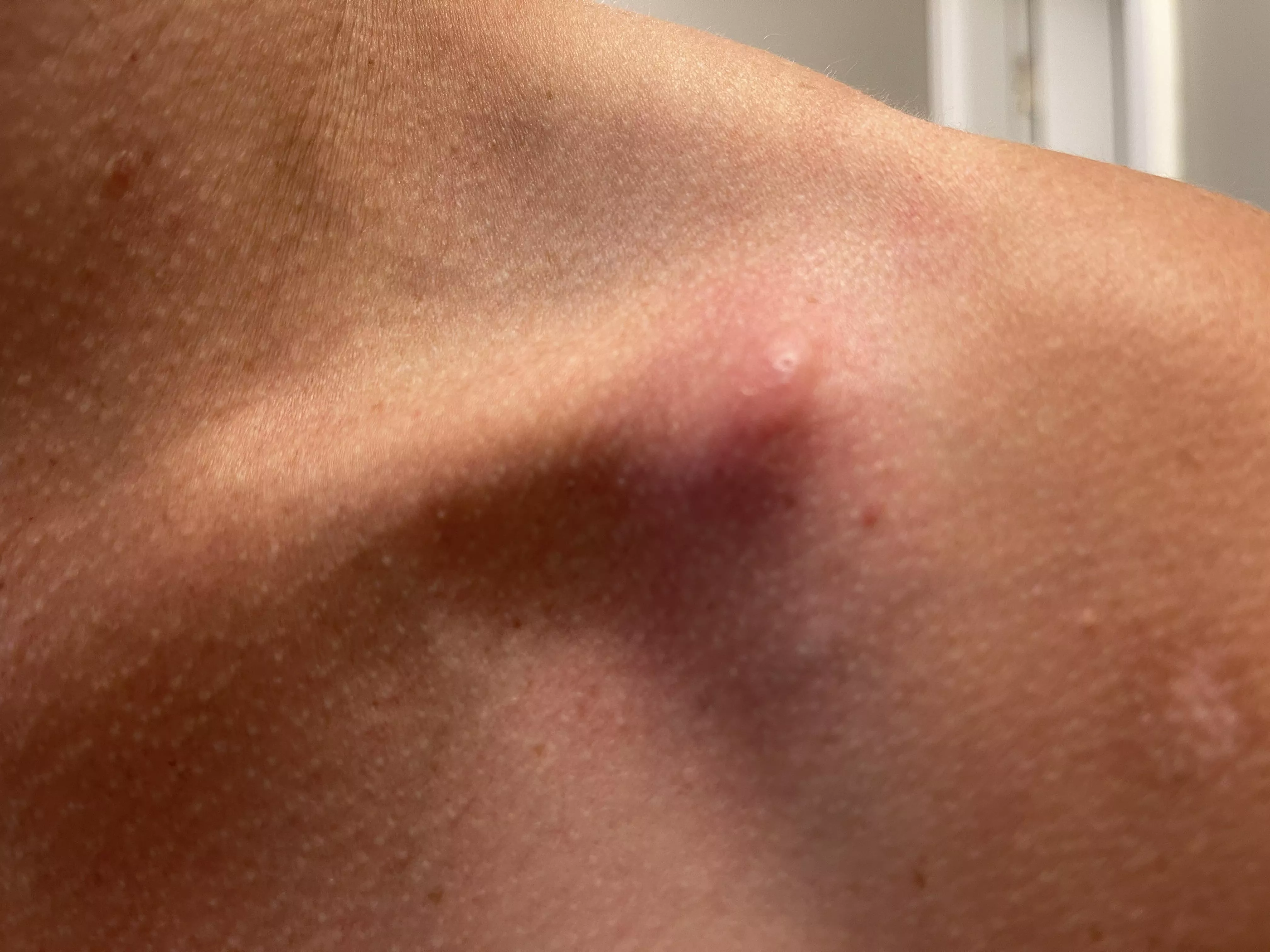 I’ll let this painful collarbone beast brew and report back