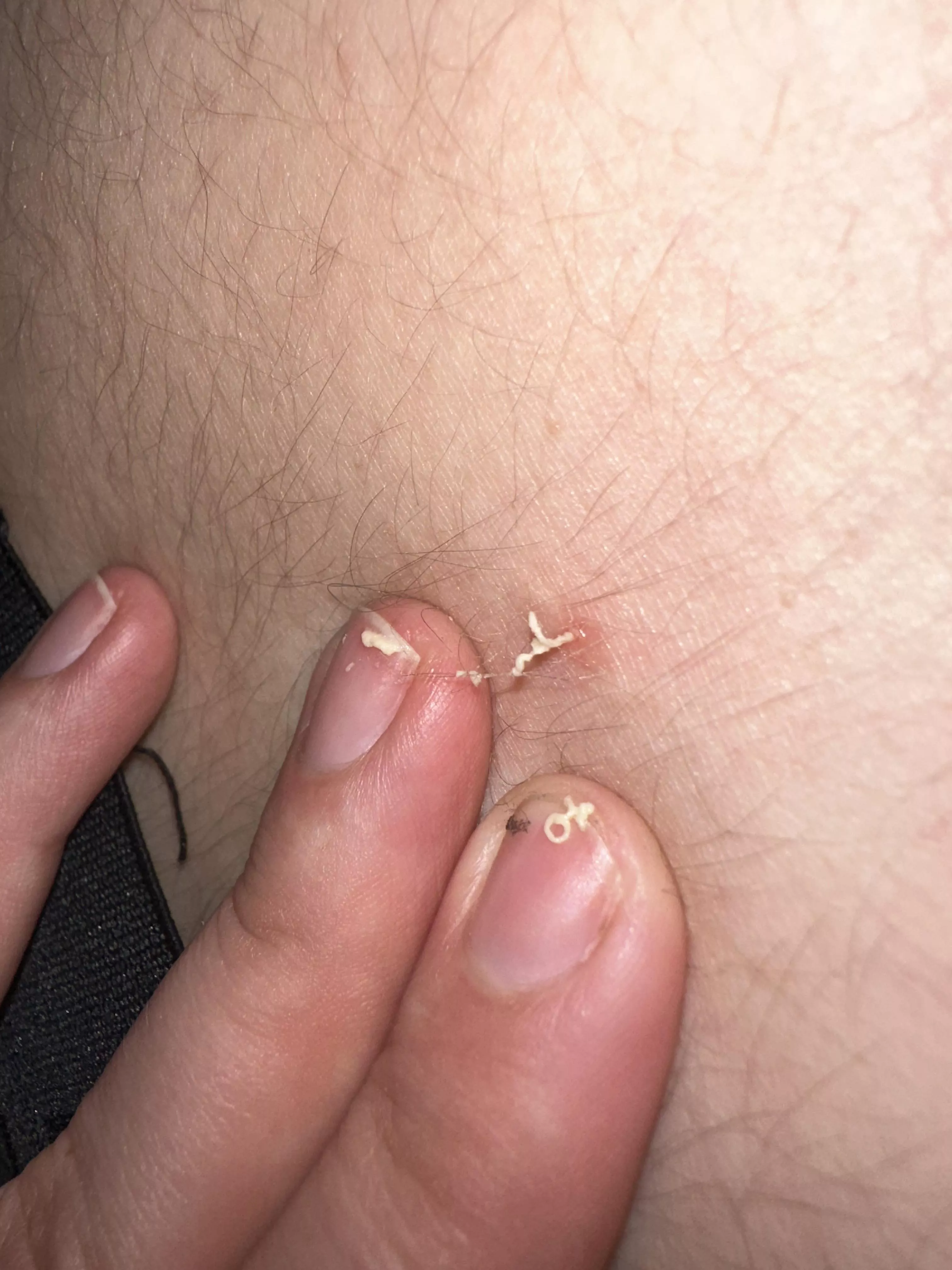 The gift that keeps on giving on my fiance’s lower back….2nd day in a row Ive been able to pop it!
