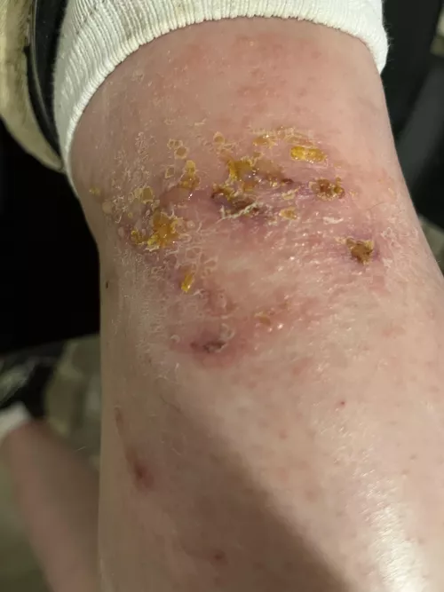 What happens when you pick at and scratch a poison ivy rash.