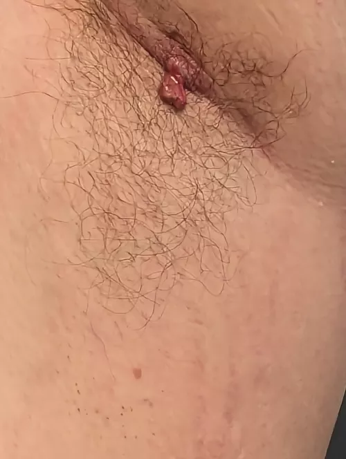 Angry armpit cyst or boil