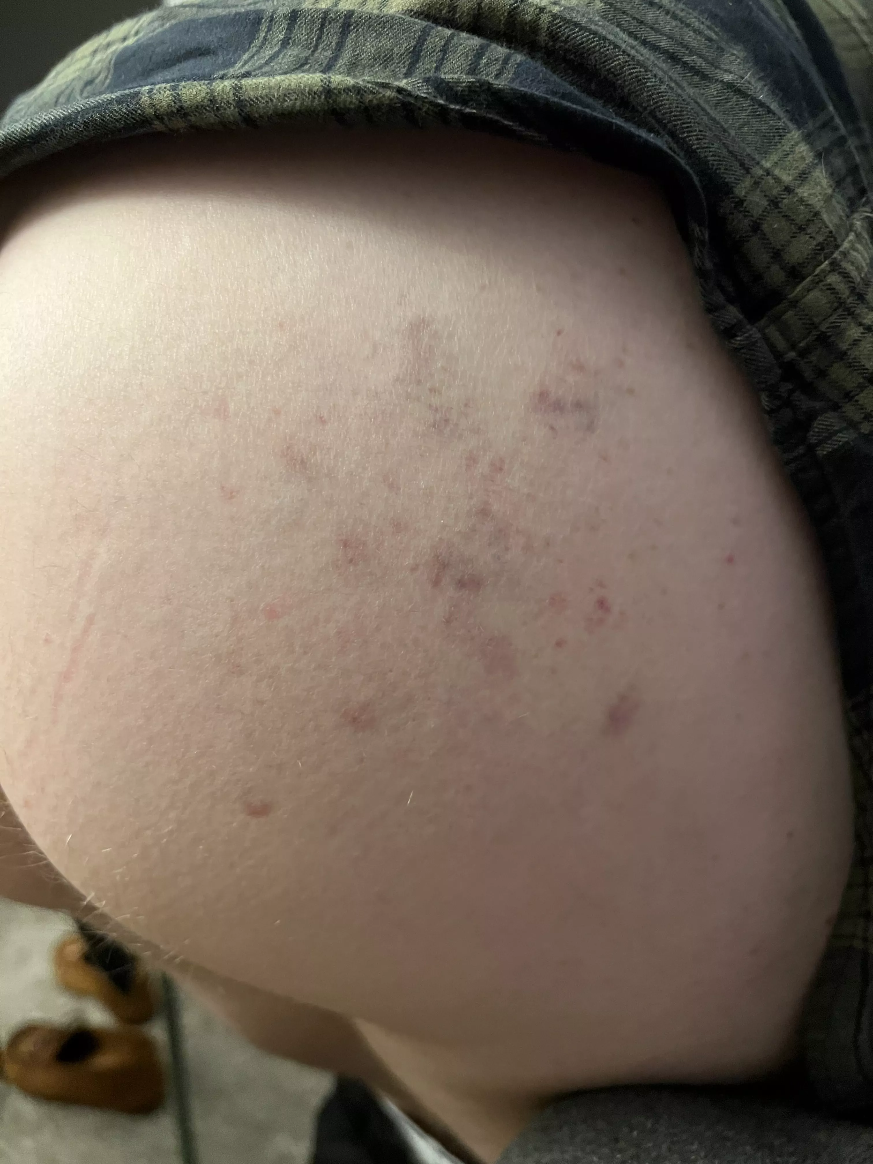 Paddling bruises - they last for days 🤤