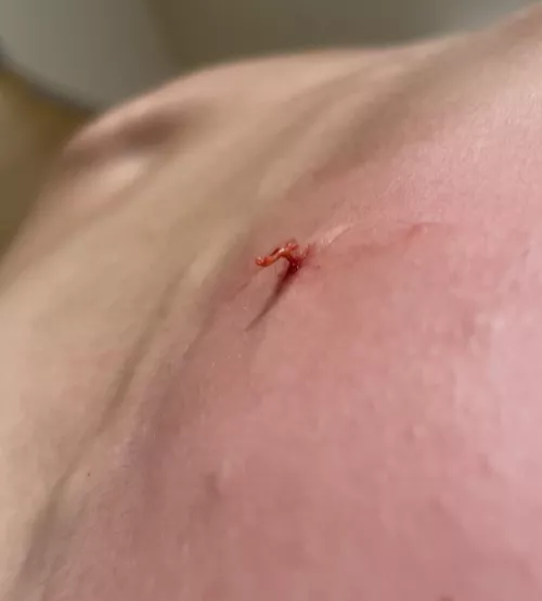 Vellus hair cyst popped