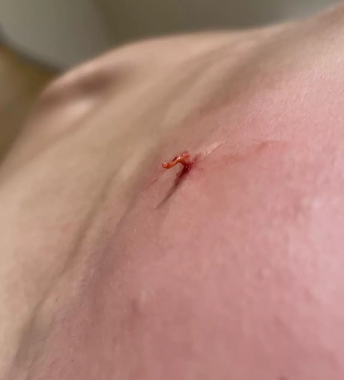 Vellus hair cyst popped