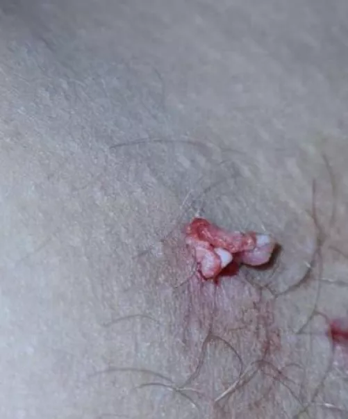 6 month cyst on thigh came to a satisfying end