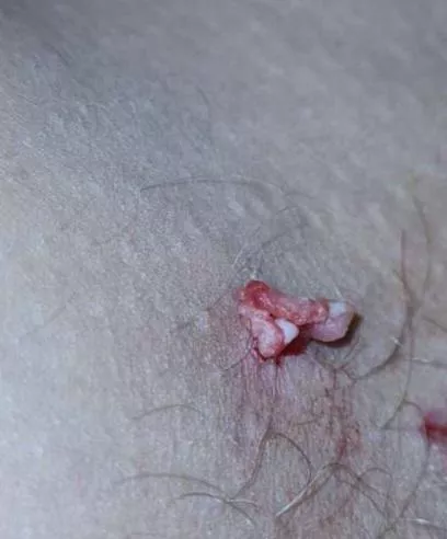 6 month cyst on thigh came to a satisfying end