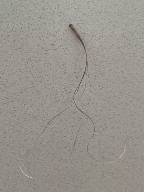 Another extracted Pili Multigemini from my beard, this one was super itchy