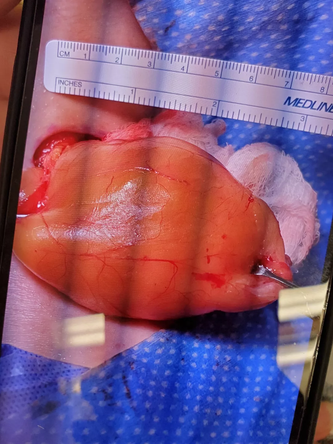 Big lipoma removed by my neck