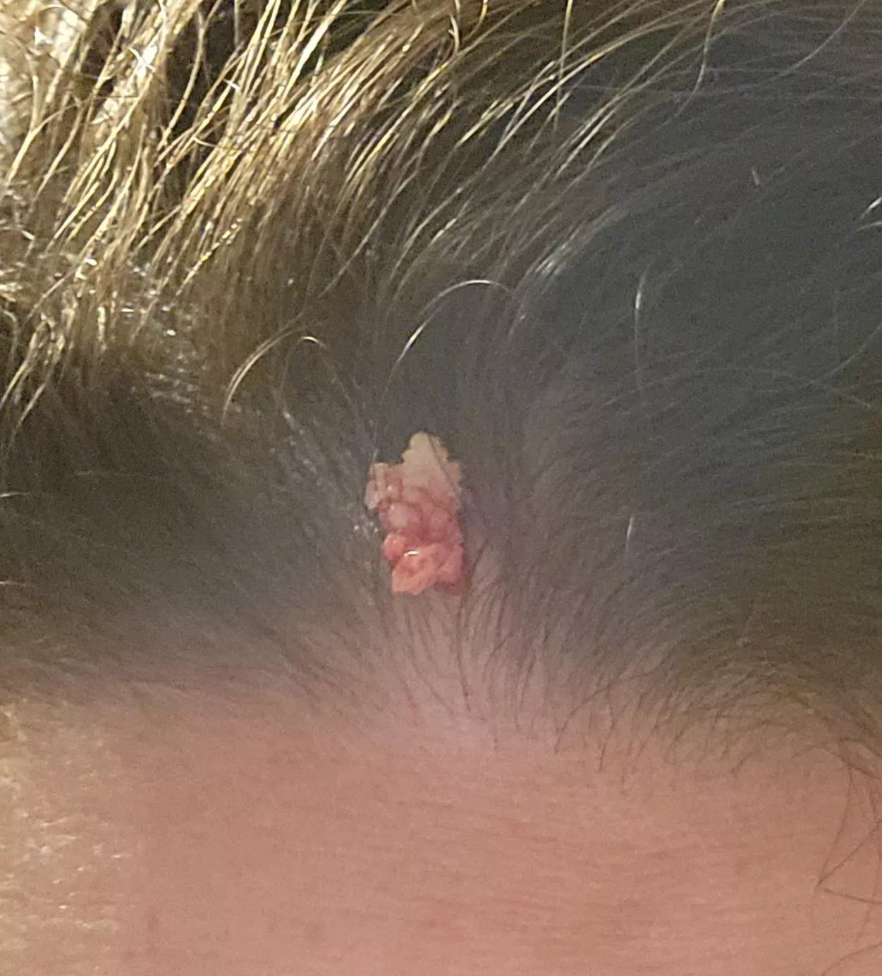 Finally popped my big hairline cyst