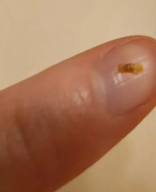 Had my belly button pierced for years. Took the piercing out a couple years ago and just got this out of the hole