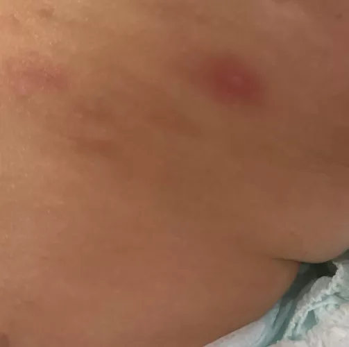 How many days do abscess continue feeling hard and a little red after draining ?