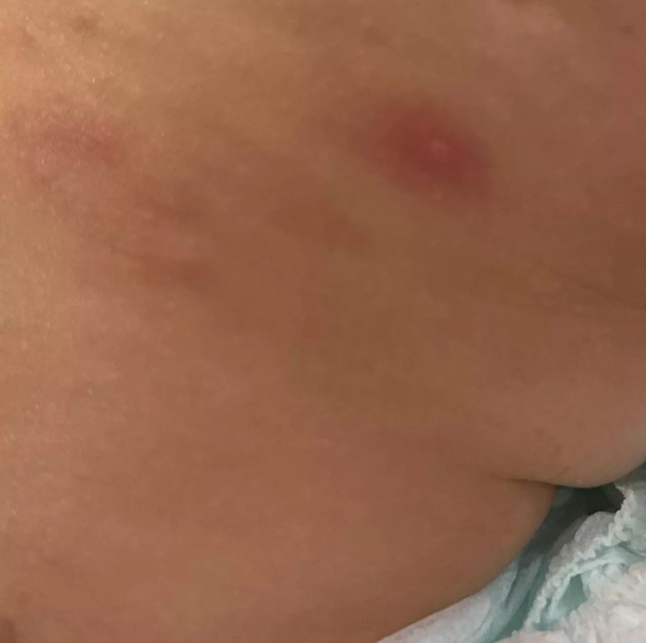 How many days do abscess continue feeling hard and a little red after draining ?