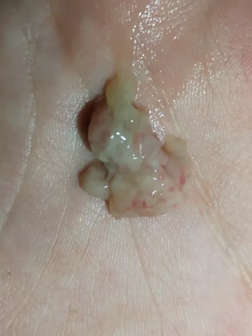 Just blew this bad boy out of my nose. Feels like a piece of my brain came out