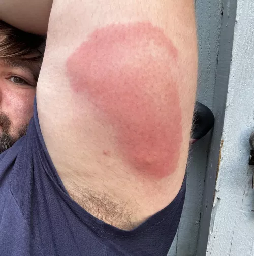 Spider bite last night
