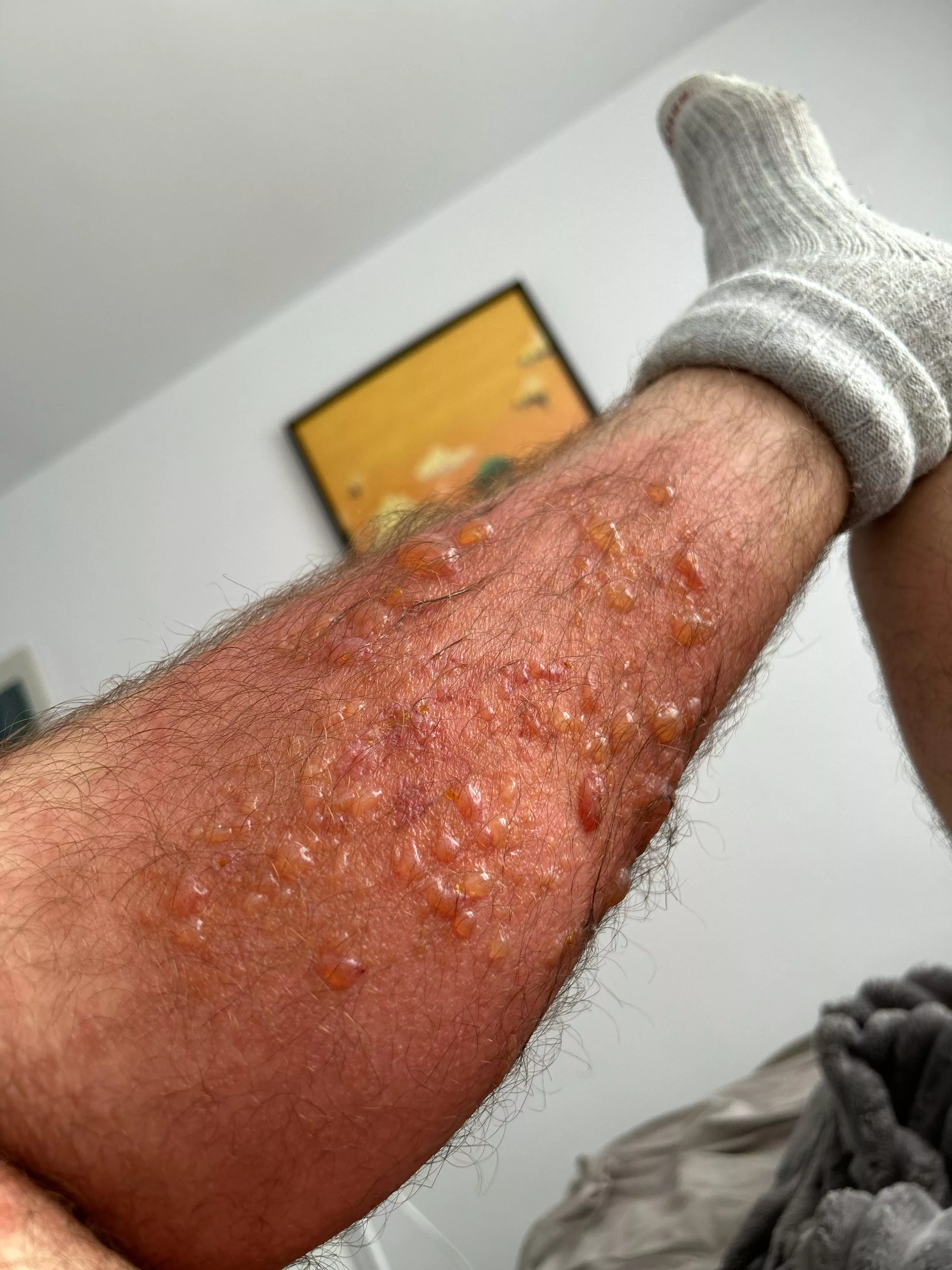 Sick and tired of poison ivy