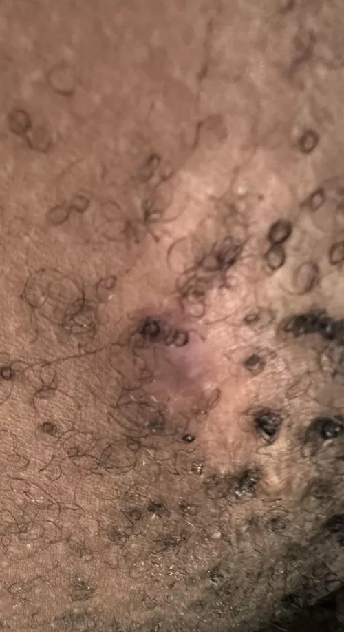 Abscess. Should I go to ER or is it too early