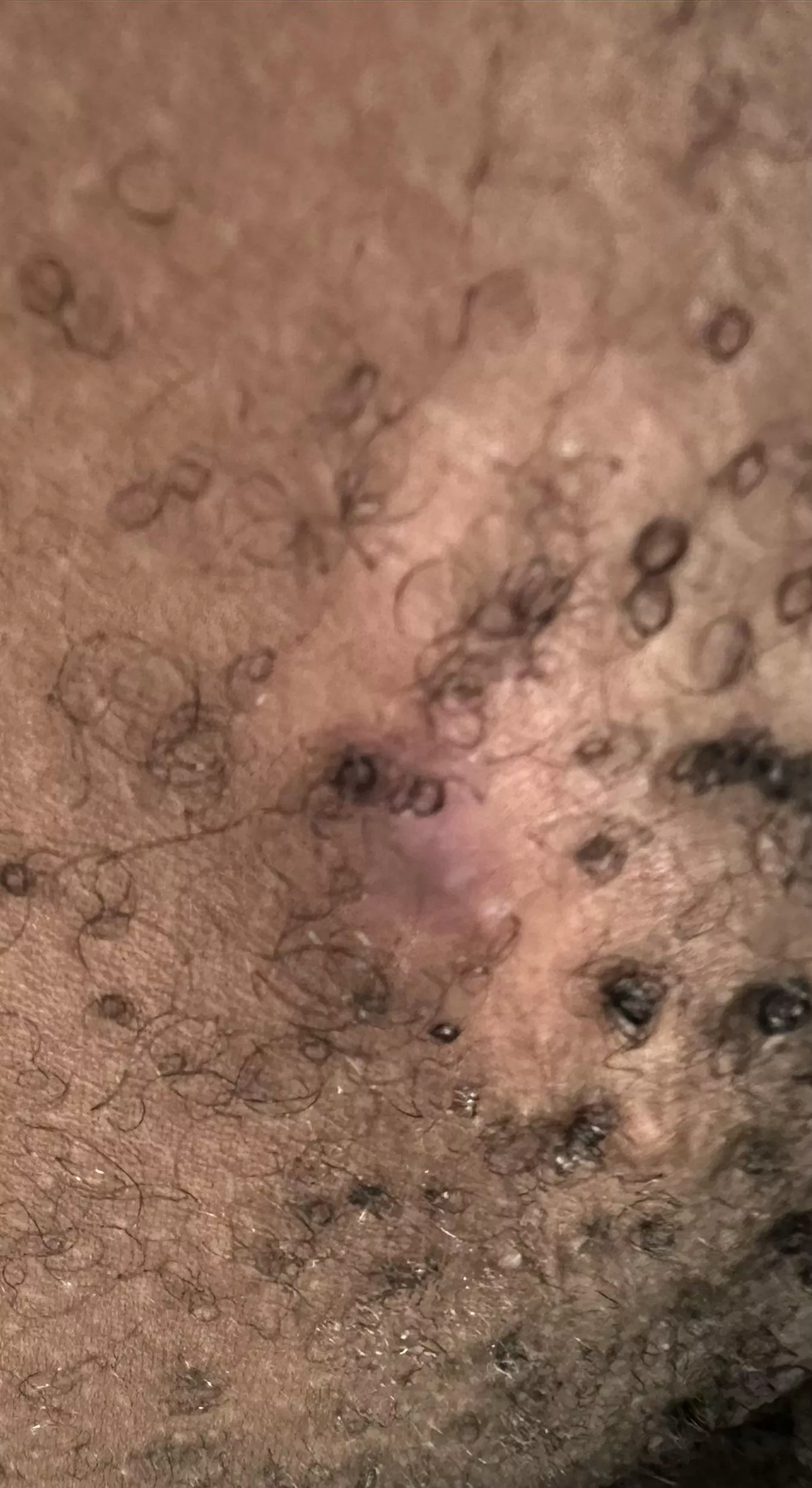 Abscess. Should I go to ER or is it too early