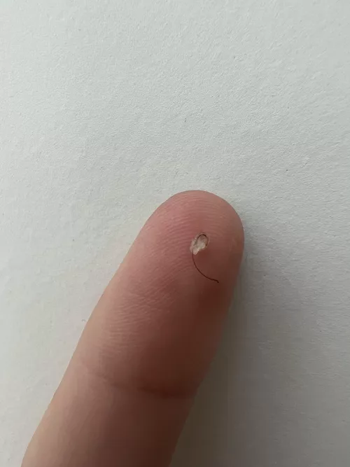 Perfect ingrown hair