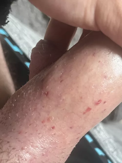 Avoiding edema post shave