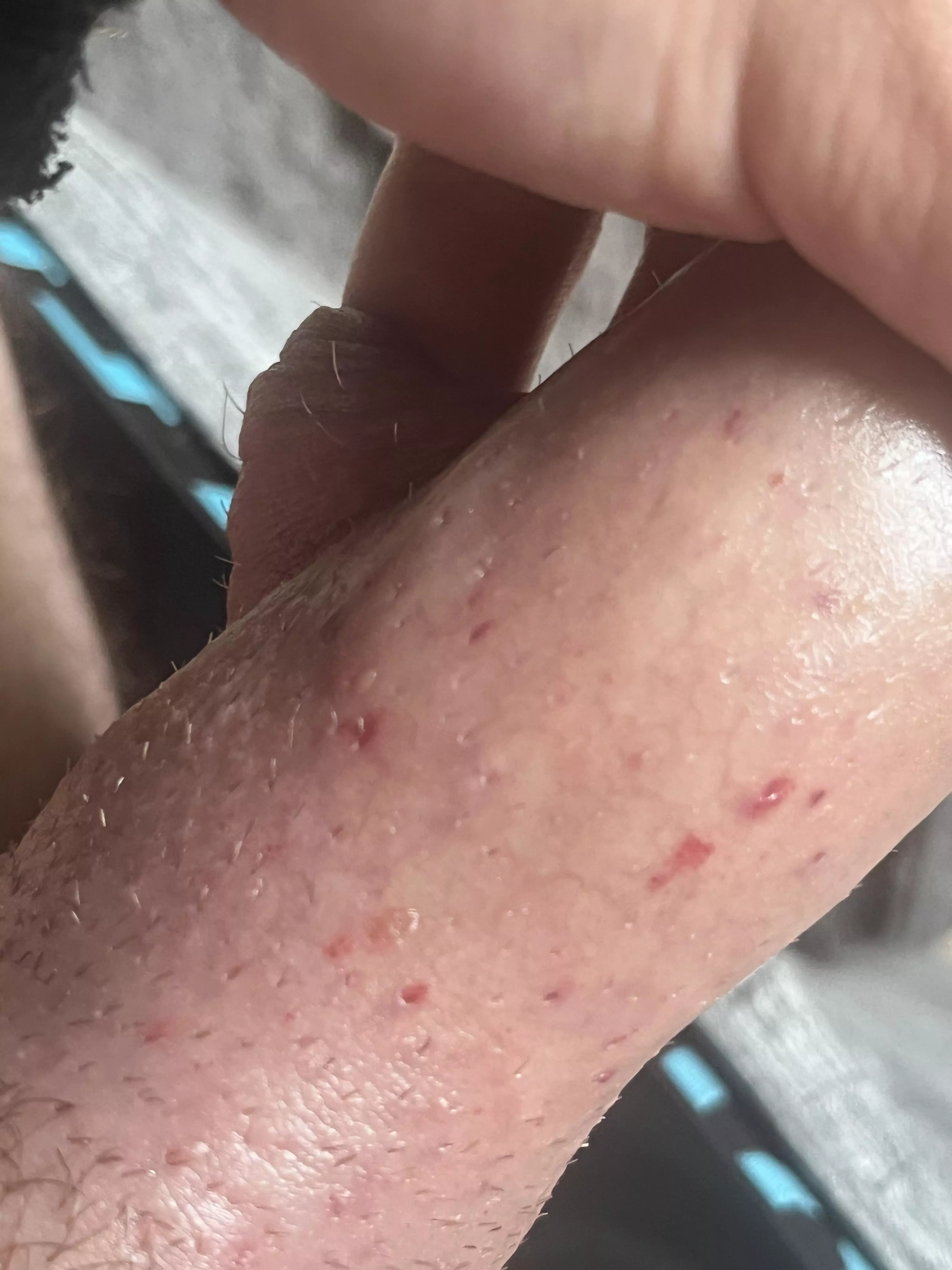 Avoiding edema post shave