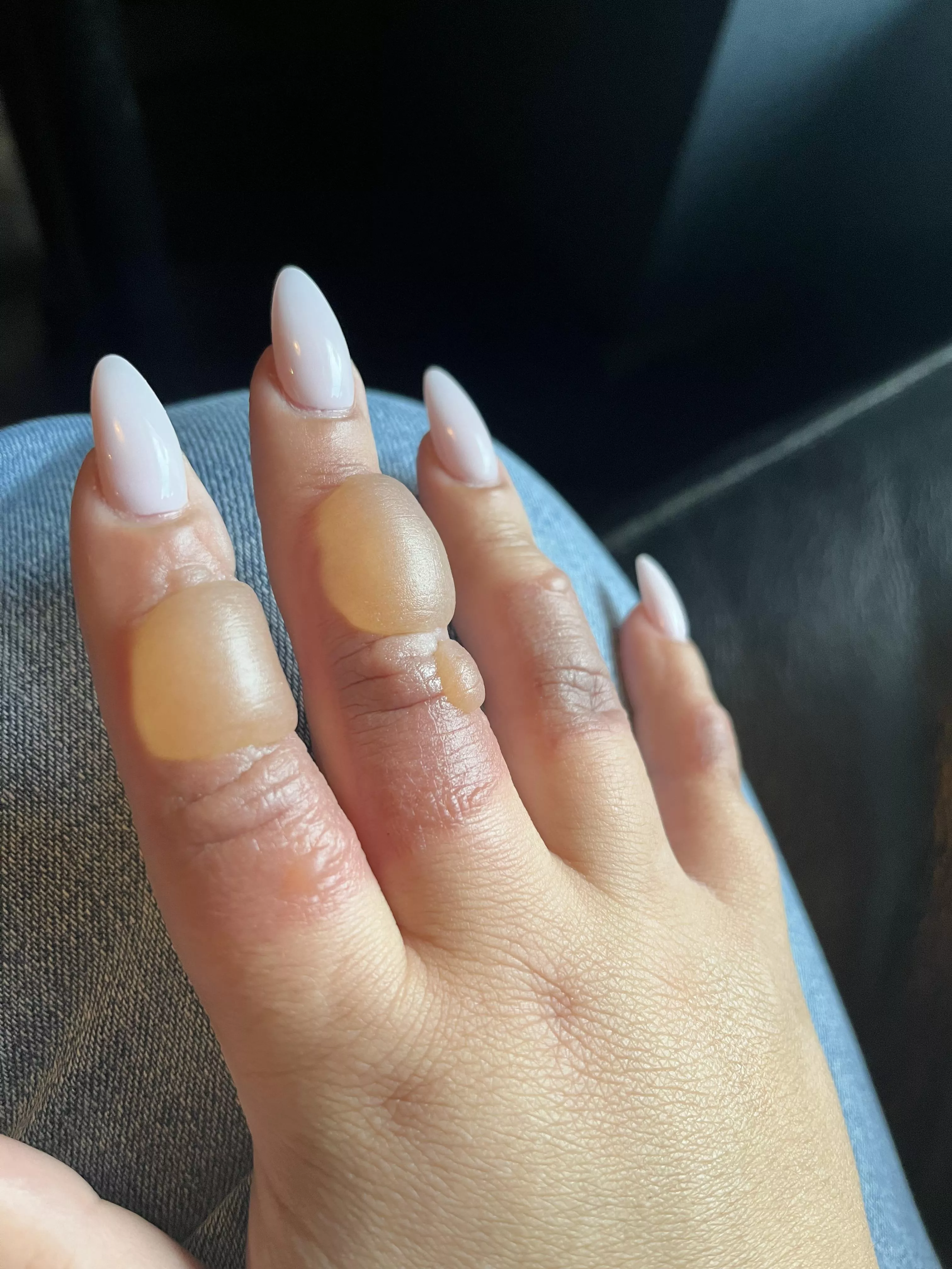 I know I can’t pop these but oh man…