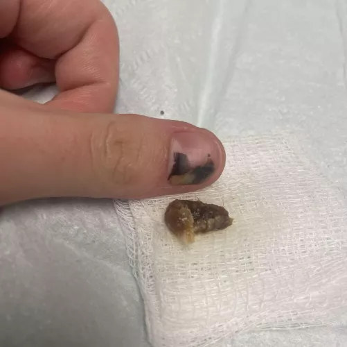 After 2 years of pain and dizziness, today I fully lost my hearing in one ear. Went to urgent care and they washed this bad boy out.