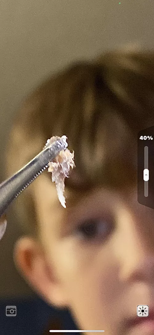 Gnarly blackhead from back