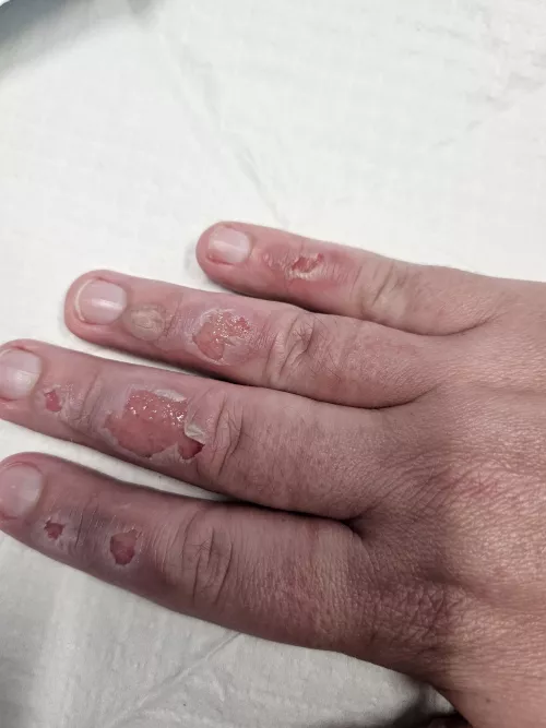 Update on the burnt fingies