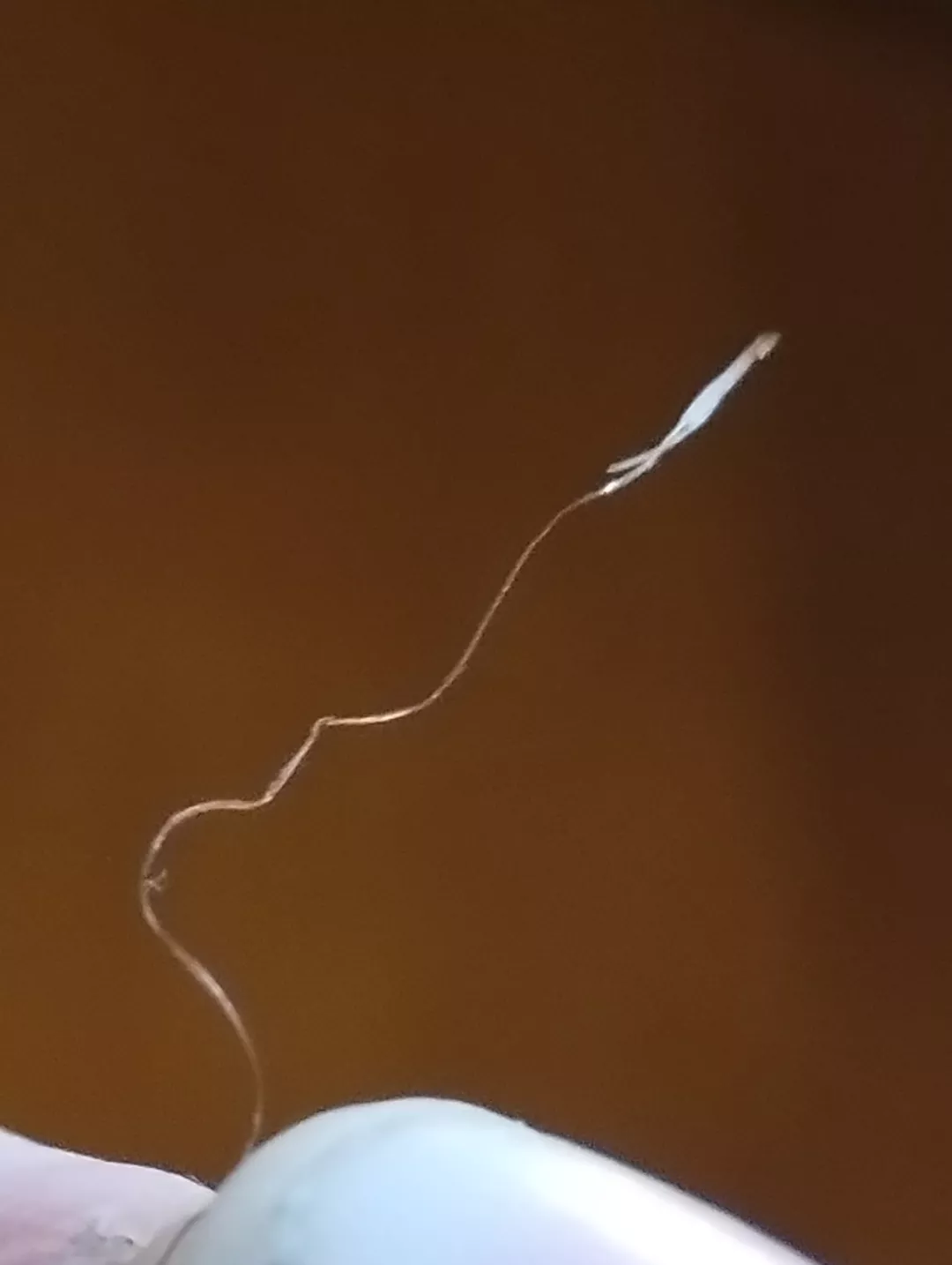 Long time lurker first time poster folliculitis hair removed with the infected hair follicle