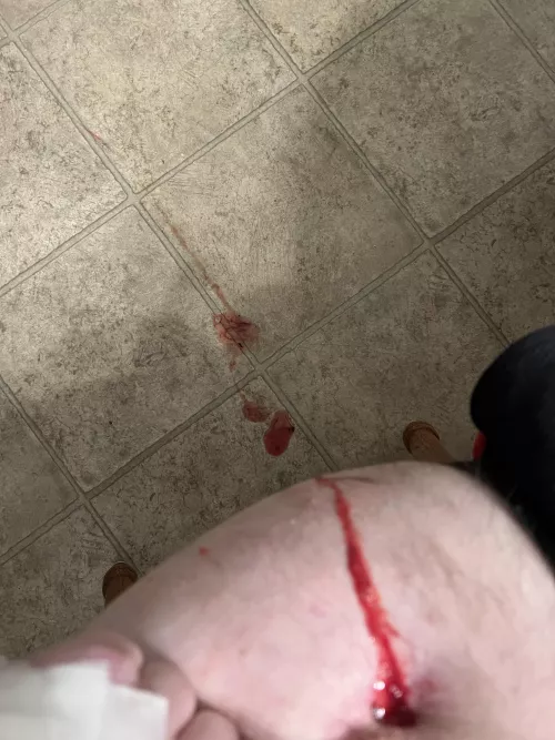 Osteomyelitis surprise explosion on my hip which flew a few feet. Photo only since I wasn’t expecting it lol. NSFW just because of upper thigh, no nudity.