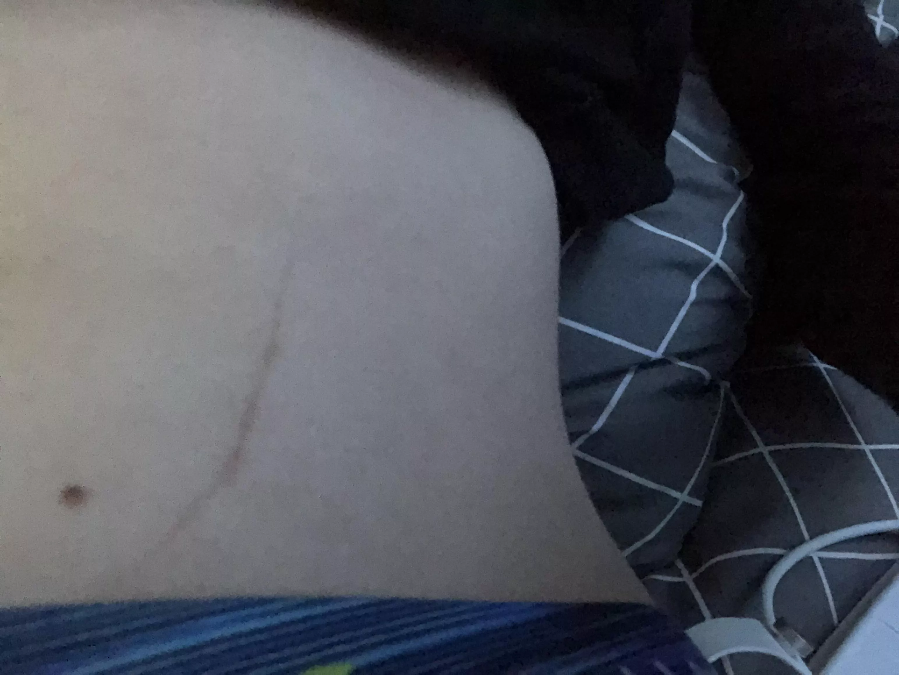 Close up of my stomach scar. Wont get into what caused it but I like how it looks tbh
