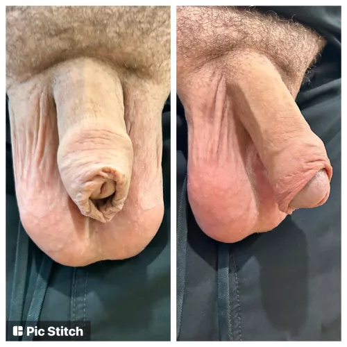 Restored foreskin. Took 7 years. Be glad you weren’t cut against your will!