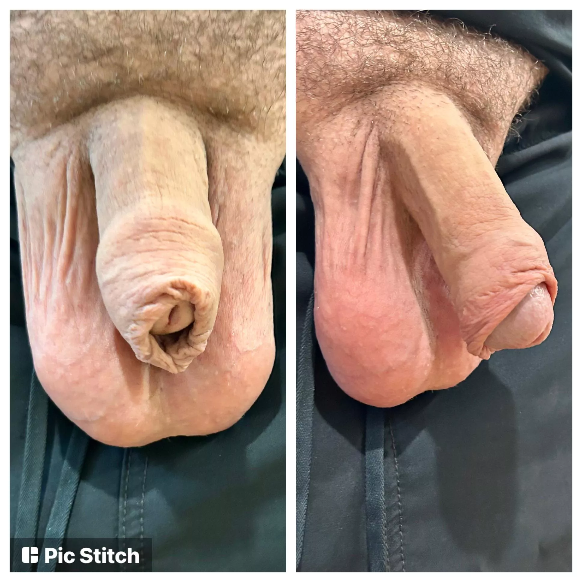 Restored foreskin. Took 7 years. Be glad you weren’t cut against your will!