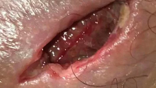 Scrotal abscess 3 separate surgeries same spot GRAPHIC!!