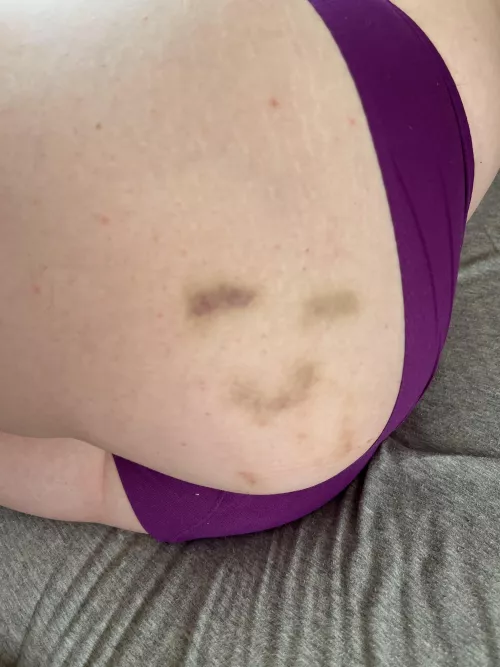 My bruises are happy to be here ☺️