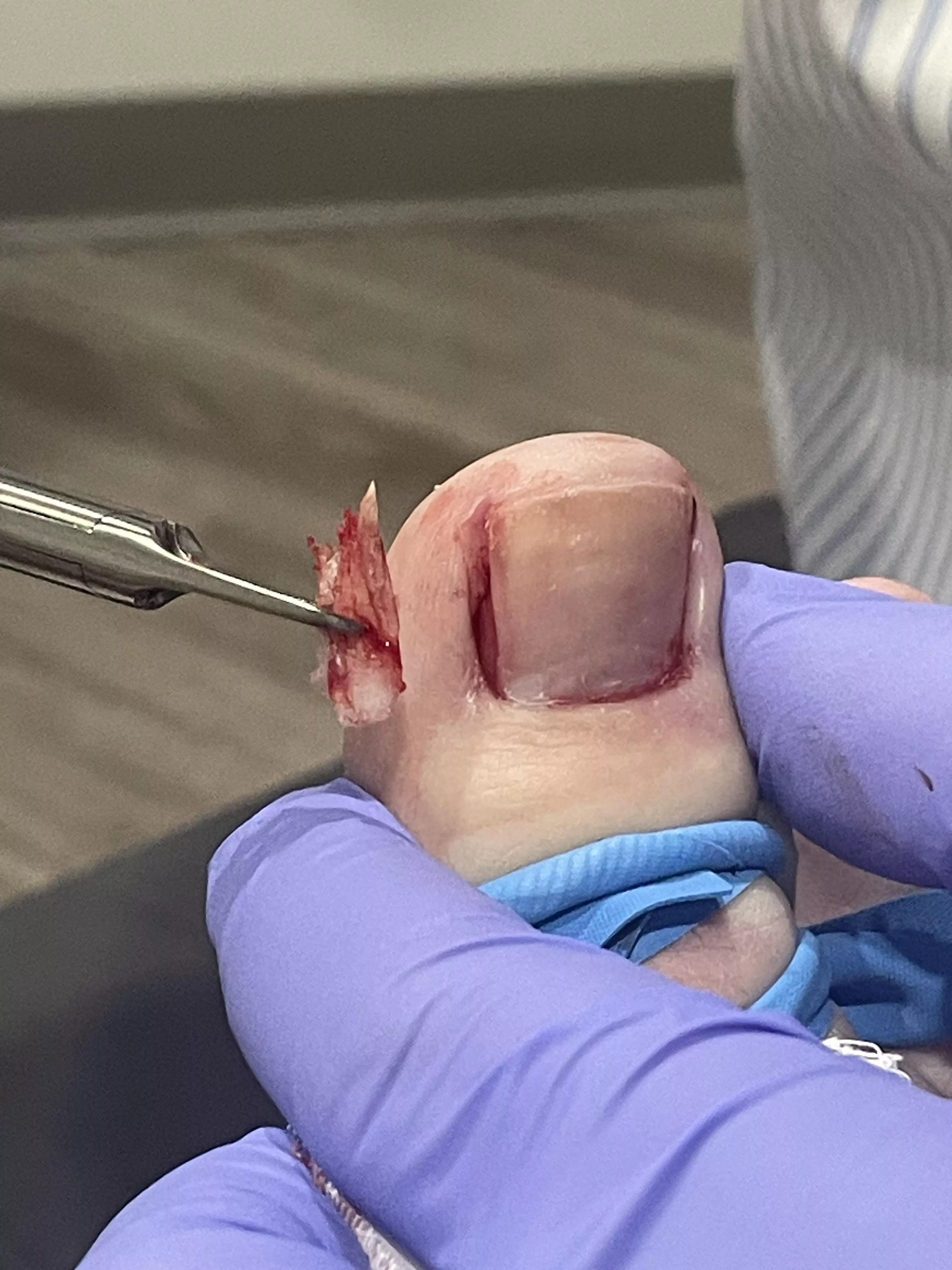 My satisfying ingrown toenail removal