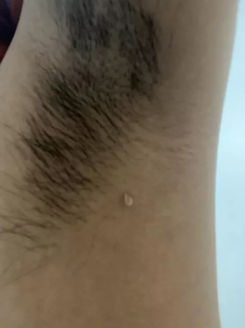 “Loose pimple” like thing under armpit